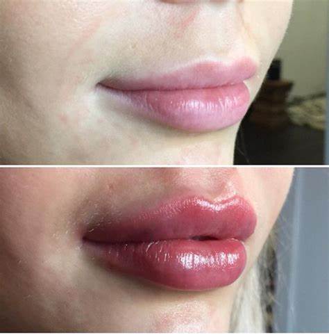 Before and after lip filler client image