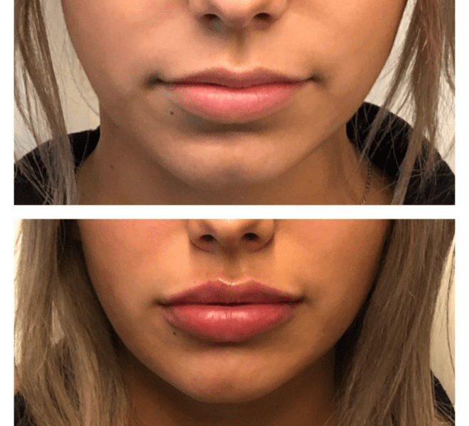 Before and after lip filler treatment images