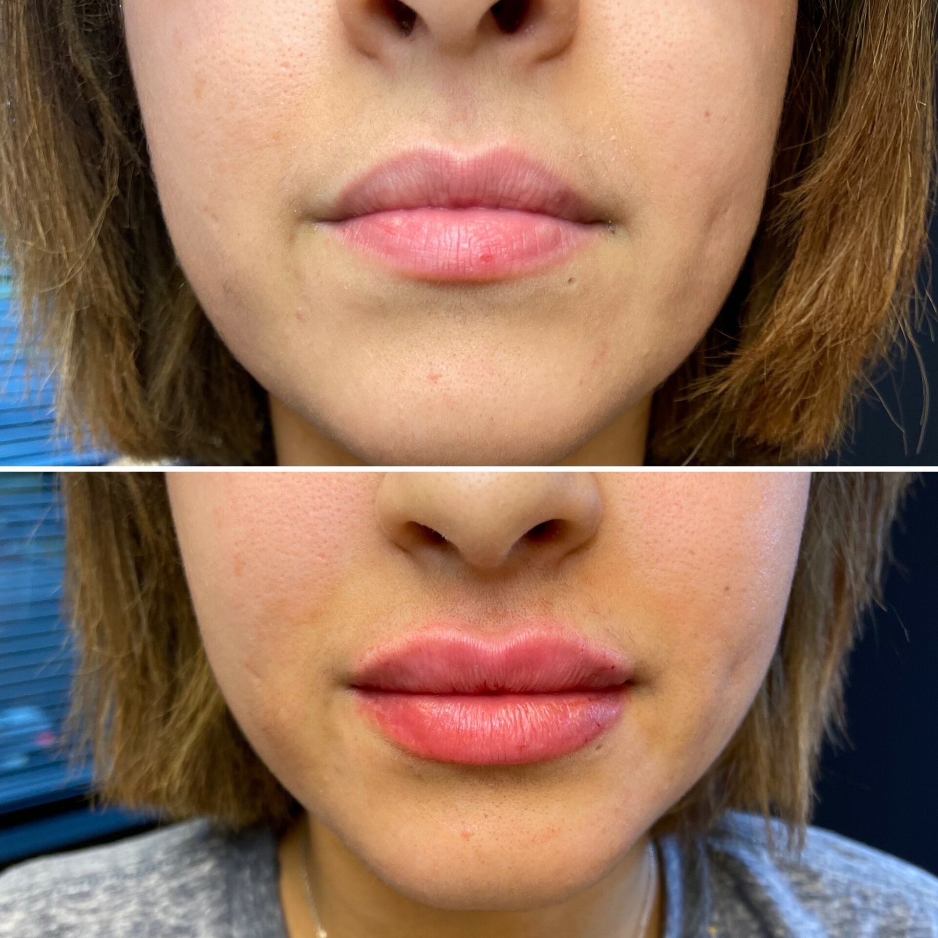 client before and after lip filler images