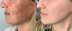 Lumecca before and after skin treatment side by side