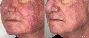 lumecca treatment results for reducing facial wrinkling