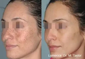 remove spotting with lumecca treatments