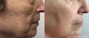 lumecca treatment on older women