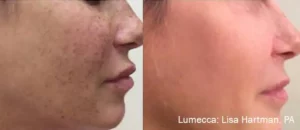 lumecca before and after, acne removal