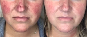 lumecca acne reduction side by side images