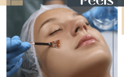 Reveal Radiant Skin: The Power of Chemical Peels