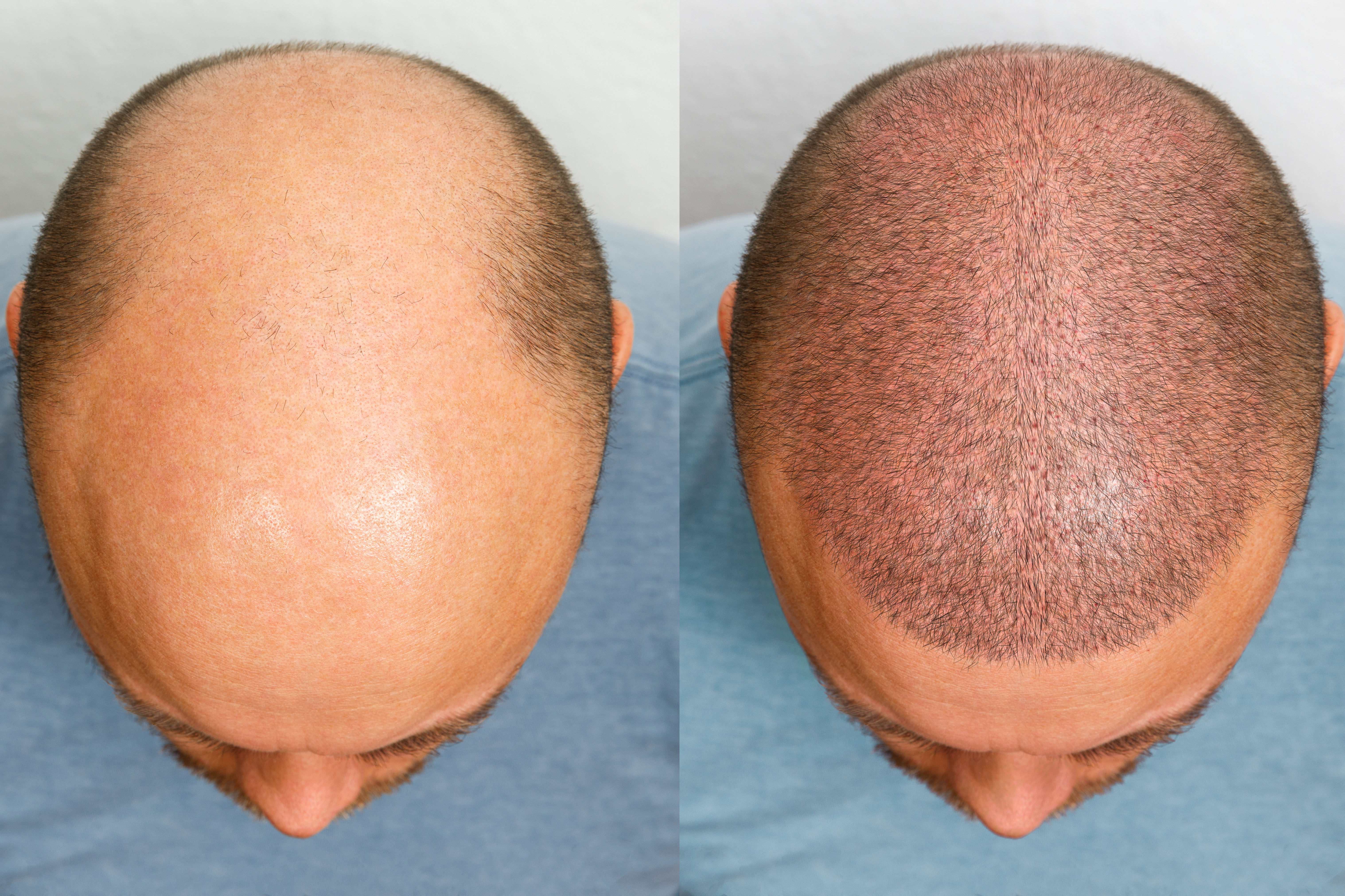 Image showing before and after of PRF treatment for hair regrowth for baldness and thinning hair