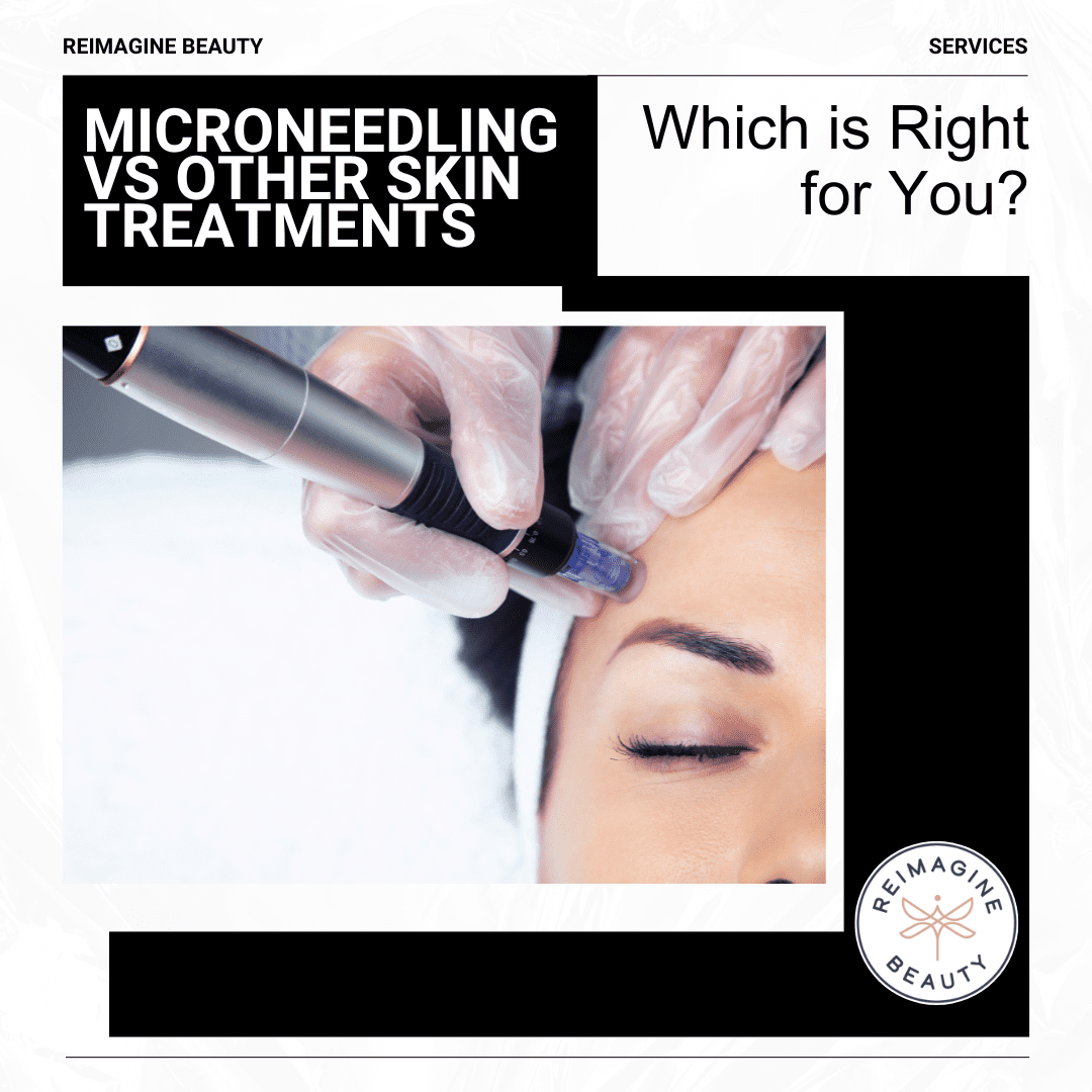 Microneedling vs other skin treatments