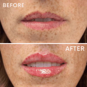 Reimagine Beauty Before and After lip filler treatment