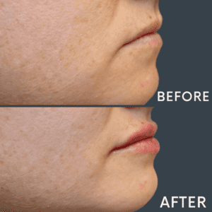 Lip Filler at Reimagine Beauty Before and After