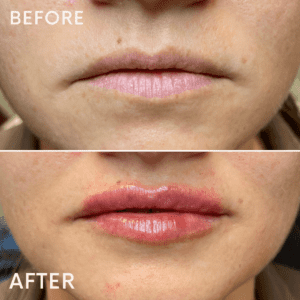 Lip Filler at Reimagine Beauty Before and After