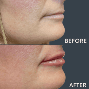 Lip Filler at Reimagine Beauty Before and After