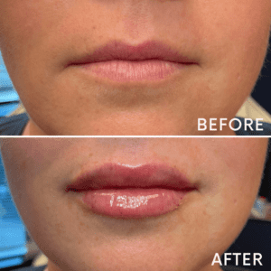 Lip Filler at Reimagine Beauty Before and After