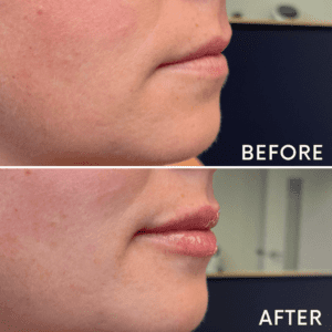 Lip Filler at Reimagine Beauty Before and After