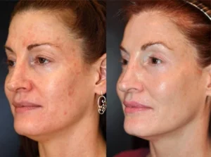 Sculptra Before and After