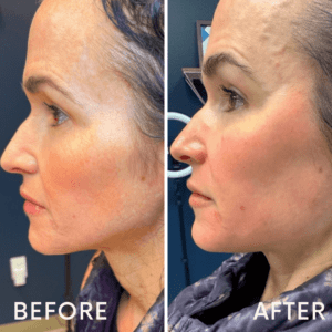 Sculptra before and after side view