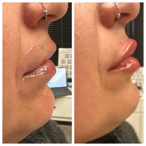 Lip Filler at Reimagine Beauty Before and After