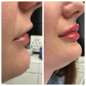 Lip Filler at Reimagine Beauty Before and After