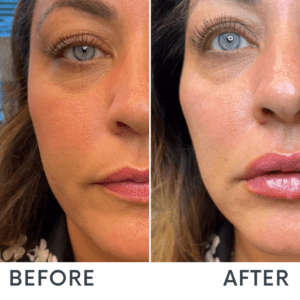 Lip Filler at Reimagine Beauty Before and After