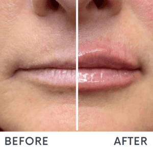 Lip Filler at Reimagine Beauty Before and After