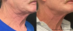 Morpheus8 Before and After neck view