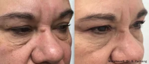 Morpheus8 Before and After eyes