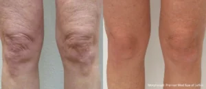 Morpheus8 Before and After Knees