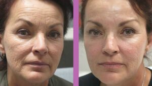 Sculptra Before and After Front