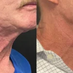 Before and after results of Morpheus8 treatment at Reimagine Beauty Lancaster Med Spa.