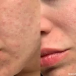 Before and after results of Morpheus8 treatment at Reimagine Beauty Lancaster Med Spa.