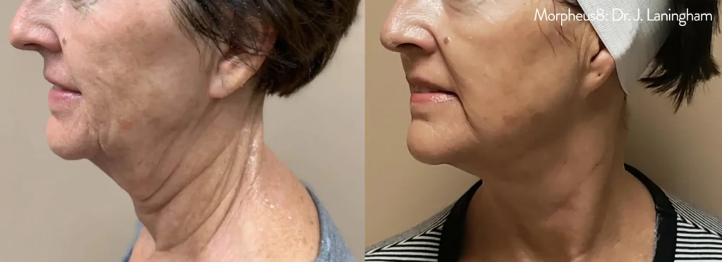 Before and after results of Morpheus8 treatment at Reimagine Beauty Lancaster Med Spa.