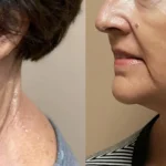 Before and after results of Morpheus8 treatment at Reimagine Beauty Lancaster Med Spa.