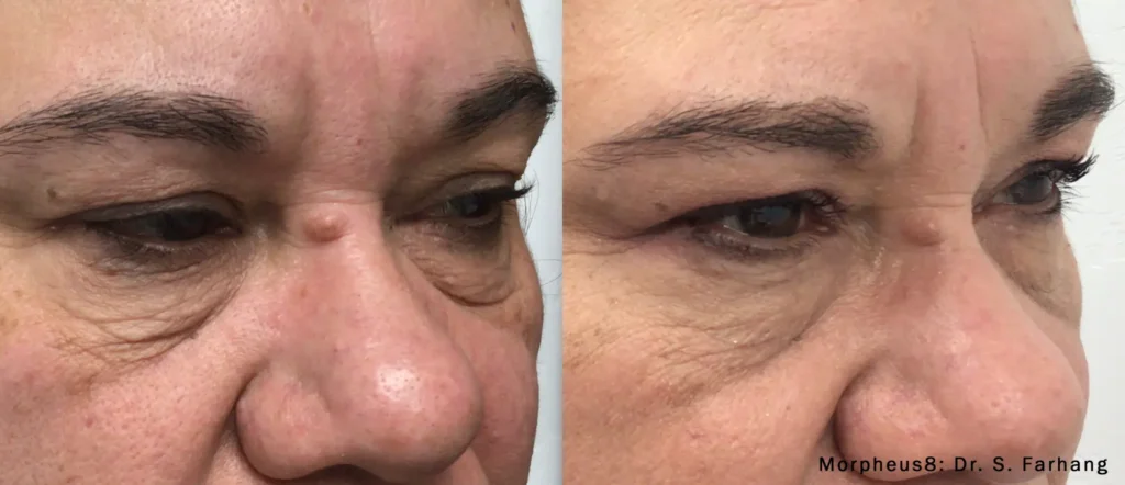 Before and after results of Morpheus8 treatment at Reimagine Beauty Lancaster Med Spa.