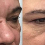 Before and after results of Morpheus8 treatment at Reimagine Beauty Lancaster Med Spa.