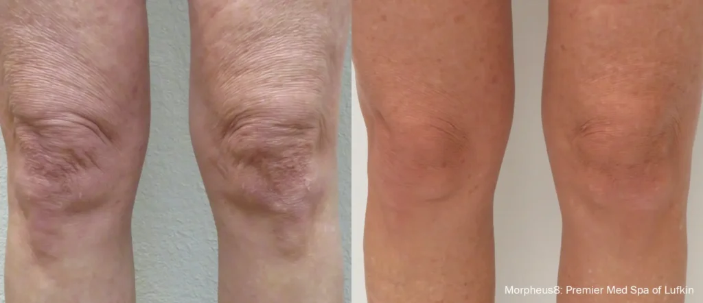 Before and after results of Morpheus8 treatment at Reimagine Beauty Lancaster Med Spa.