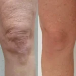 Before and after results of Morpheus8 treatment at Reimagine Beauty Lancaster Med Spa.