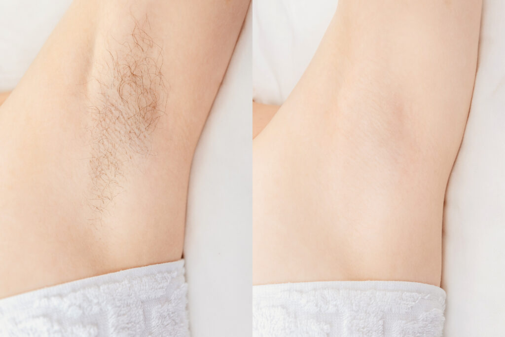 Before and after results of underarm hair removal with laser treatment at Reimagine Beauty Lancaster Med Spa.