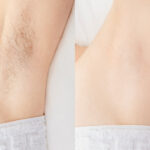 Before and after results of underarm hair removal with laser treatment at Reimagine Beauty Lancaster Med Spa.