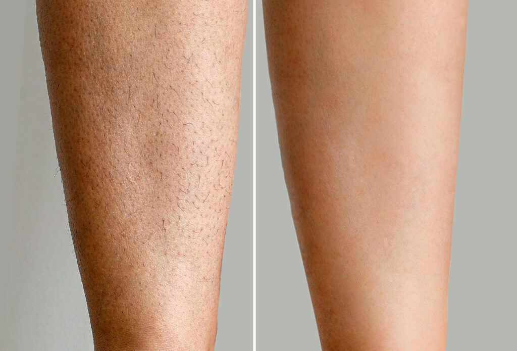 Before and after results of laser hair removal treatment on a woman's legs at Reimagine Beauty Lancaster Med Spa.