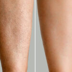Before and after results of laser hair removal treatment on a woman's legs at Reimagine Beauty Lancaster Med Spa.