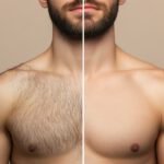 Before and after results of laser hair removal treatment on male chest at Reimagine Beauty Lancaster Med Spa.