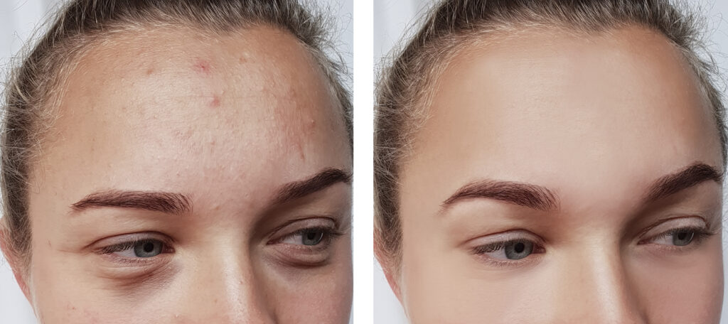 Before and after results of Acne Bootcamp treatment for eye wrinkles at Reimagine Beauty Lancaster Med Spa.