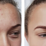 Before and after results of Acne Bootcamp treatment for eye wrinkles at Reimagine Beauty Lancaster Med Spa.