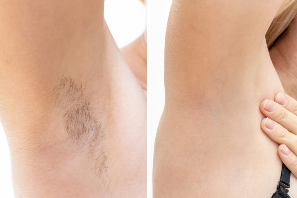 Before and after results of sugaring services for underarm hair removal at Reimagine Beauty Lancaster Med Spa.