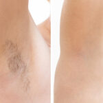 Before and after results of sugaring services for underarm hair removal at Reimagine Beauty Lancaster Med Spa.