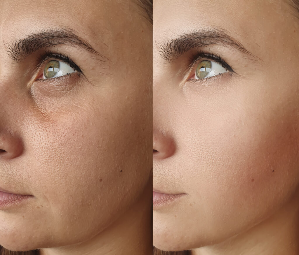 Before and after results of microneedling treatment at Reimagine Beauty Lancaster Med Spa.