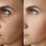 Before and after results of microneedling treatment at Reimagine Beauty Lancaster Med Spa.