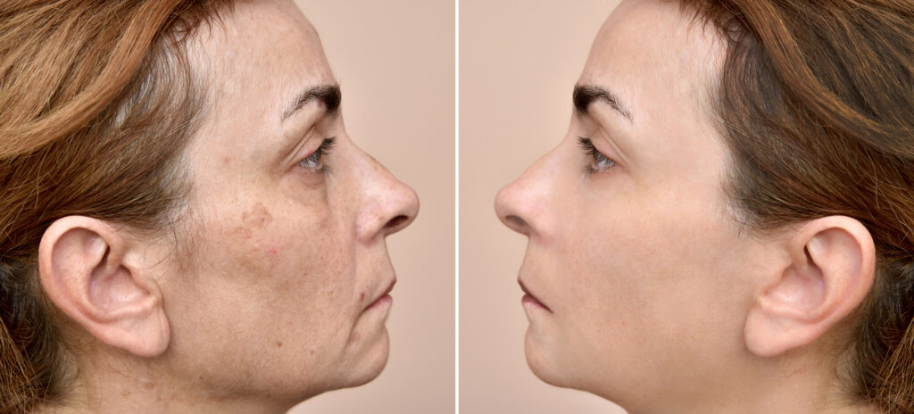 Before and after results of chemical peels treatment at Reimagine Beauty Lancaster Med Spa.