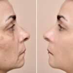Before and after results of chemical peels treatment at Reimagine Beauty Lancaster Med Spa.