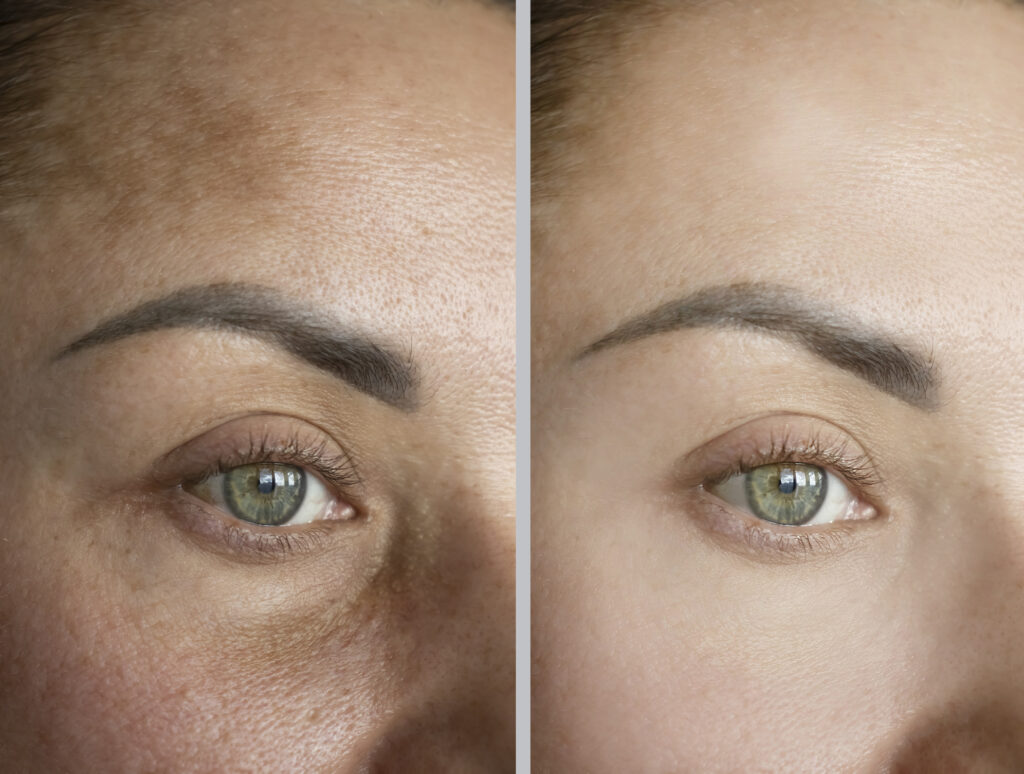 Before and after results of HydraFacial treatment at Reimagine Beauty Lancaster Med Spa.